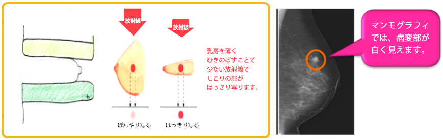 マンモグラフィ