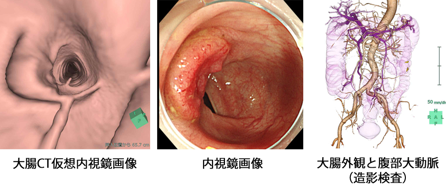 大腸CT検査画像