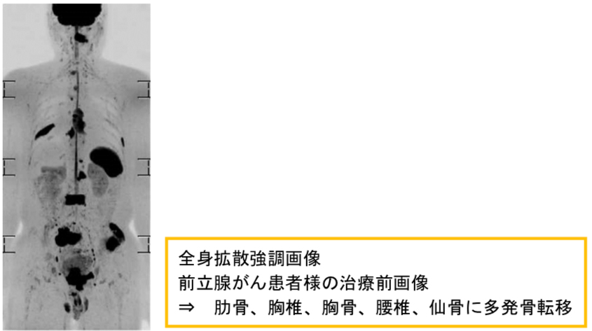 全身拡散強調画像 全身拡散強調画像